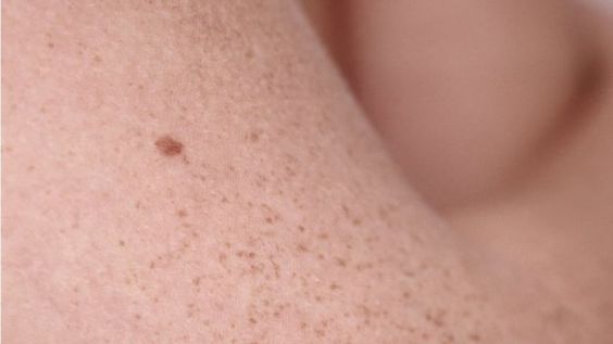 Makna Tahi Lalat di Tubuh, Bisa Jadi Nasib Baik Dan Buruk