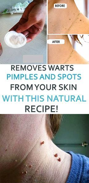 Pin On Beauty Tips Makeup - Diy Wart Removal On Arm Pin On Beauty Tips Makeup - Diy Wart Removal On Arm