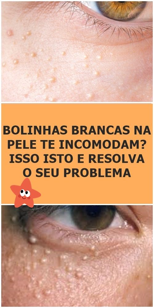 dieta cu vene varicoase la barbai