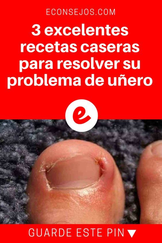 Pin En Varices