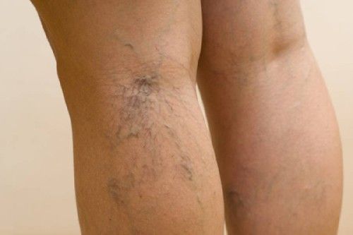 dolor en las piernas por varices internas