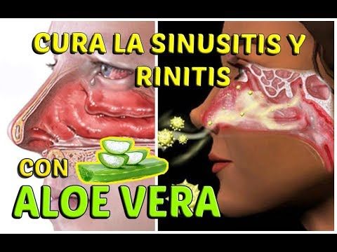 como sanar la gripe naturalmente