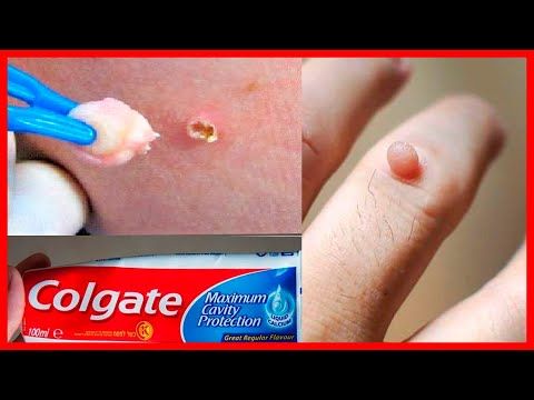 Remueve Las Verrugas De La Piel En Una Sola Noche De Aplicación Remedios Caseros Youtu Remedios Para Verrugas Como Quitar Verrugas Como Eliminar Las Verrugas
