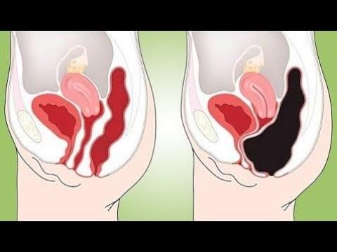 placă de colon detox supliment dietetic rapid de detoxifiere