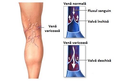 ierburi vindecate vene varicoase