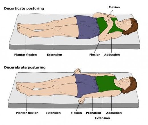 pics Decorticate Posture Vs Decerebrate pinterest