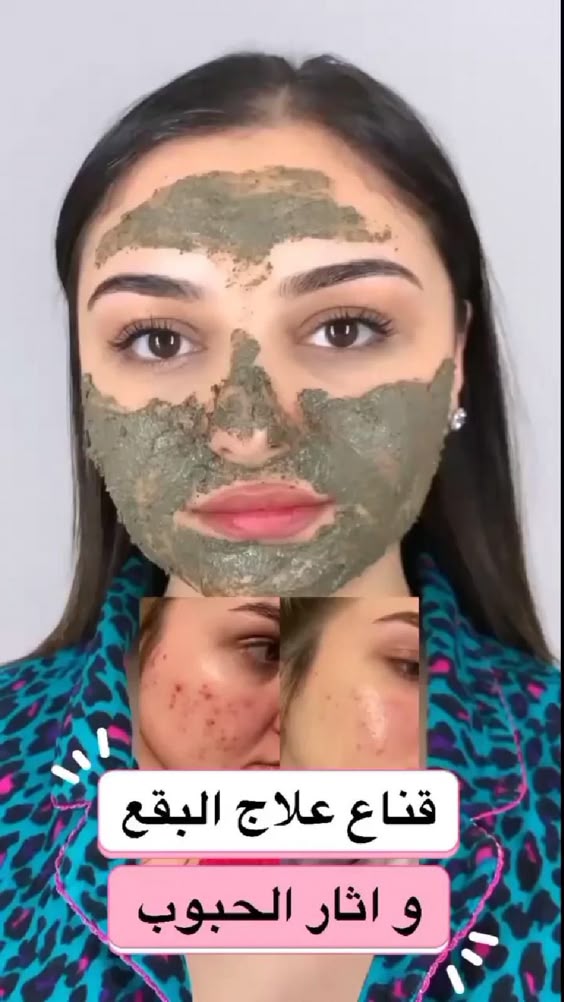علاج البقع 💁\u200d♀️❤️