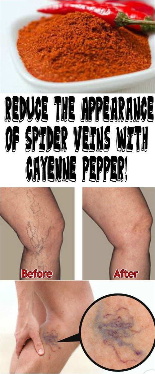 cayenne pepper for varicose veins