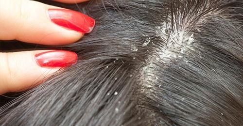 تفسير حلم القمل في الشعر للمتزوجة وقتله Hair Lice Shiny Hair Dandruff