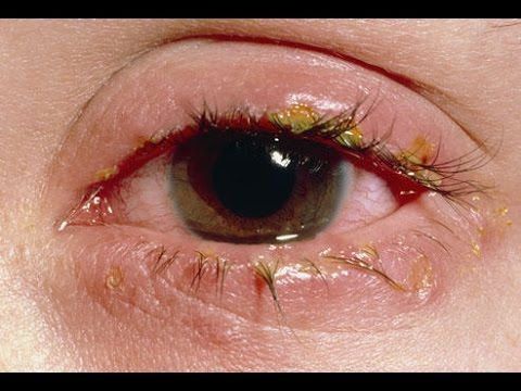 Eye Diseases Black Floaters In Eye Floater Eye What Are Floaters In The Eyes Eyeball Floaters Http Curing Eye Blepharitis Floaters Eye Dry Skin Remedies Eye Diseases Black Floaters In Eye Floater Eye What Are Floaters In The Eyes Eyeball Floaters Http Curing Eye Blepharitis Floaters Eye Dry Skin Remedies