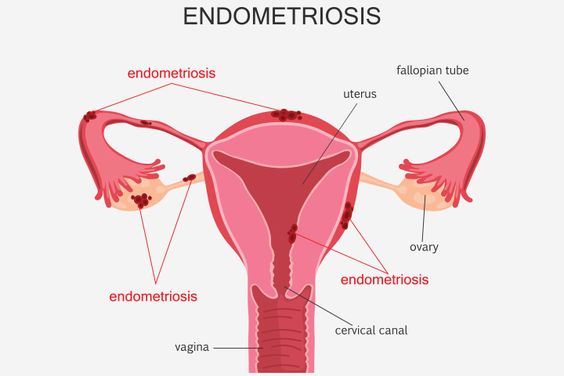 Can You Get Pregnant Without Fallopian Tubes Pcos Causes Infertility Getting Pregnant Tips Pregnant Faster Get Pregnant Fast