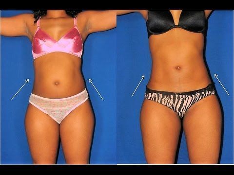 Bilder von menschlichen Barbies vor und nach dem Abnehmen