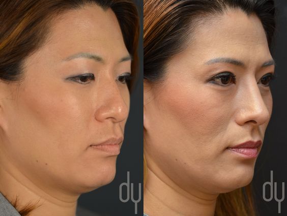 Rhinoplasty before and after pictures asian dresses Rhinoplasty before and after pictures asian dresses