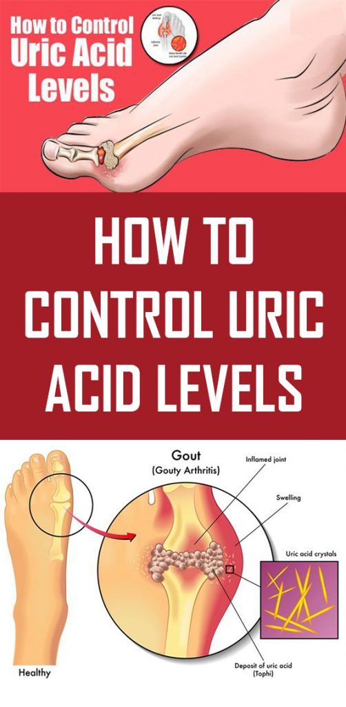 How to Control Uric Acid Levels