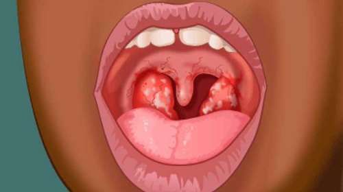 causas de infeccion bacteriana en la garganta causas de infeccion bacteriana en la garganta