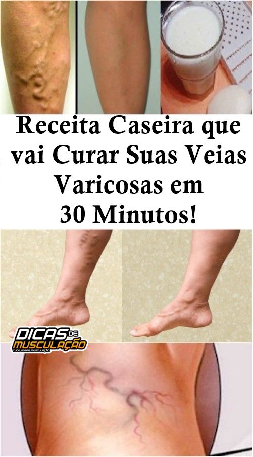 E como da veias varizes naturalmente das livrar se aranha