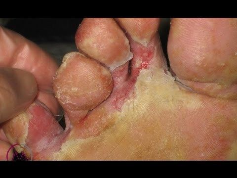 como cuidar una infección de levadura naturalmente como cuidar una infección de levadura naturalmente
