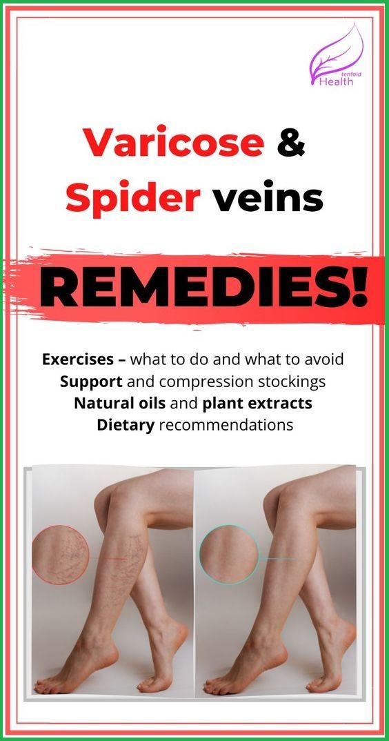 Can You Get Rid Of Spider Veins With Exercise 3 Natural Ways To Get Rid Of Spider Veins Spider Veins Get Rid Of Spider Veins 21 Day Workout