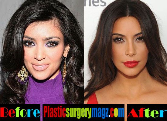 Kim Kardashian but Implants Before and After Kim Kardashian - plastic surgery consultant sample resume Kim Kardashian but Implants Before and After Kim Kardashian - plastic surgery consultant sample resume