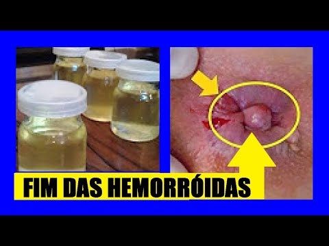 remédio caseiro para curar hemorróida interna
