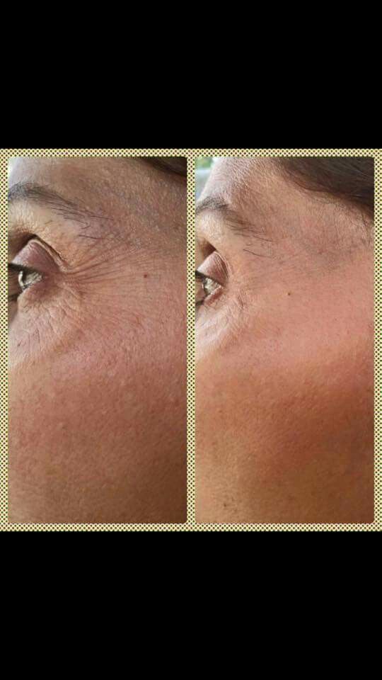 Lr Healht Beauty Serox Goz Pedi Uygulamasi Lr Healht Beauty Serox Goz Pedi Uygulamasi