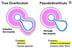 false vs true diverticulum - Google Search