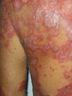 Changing what you eat can make all the difference in the world, especially if you have psoriasis.