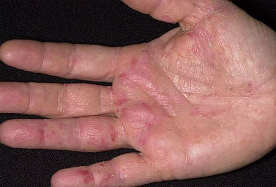 bệnh tổ đỉa là gì