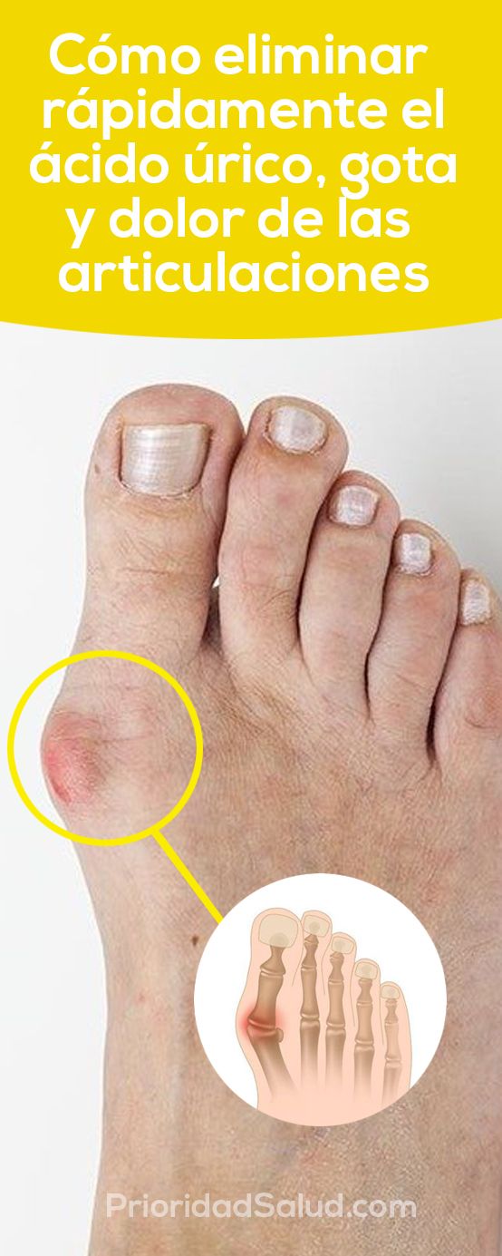 Cómo Eliminar Rápidamente El ácido úrico Gota Y Dolor De Las Articulaciones Health Mantras Healthy Recipes