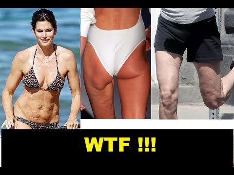 celulitis y estrias celulitis y estrias