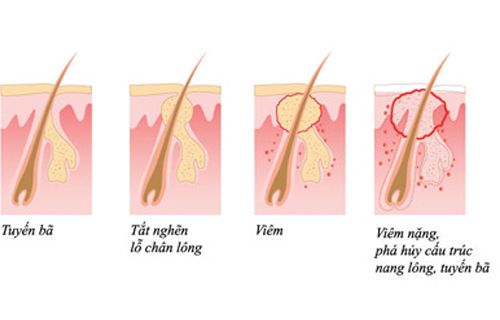 nguyên nhân phổ biến của mụn bọc
