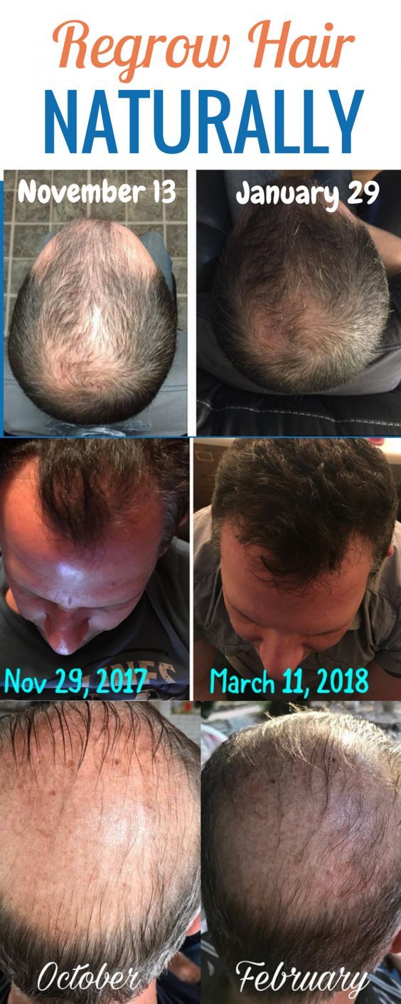 Everyday Health Care This Mixture Only 2 Ingredients Apply To Hair Will Get Rid Of Grey Hair N Natural Gray Hair Natural Hair Styles Grey Hair Home Remedies