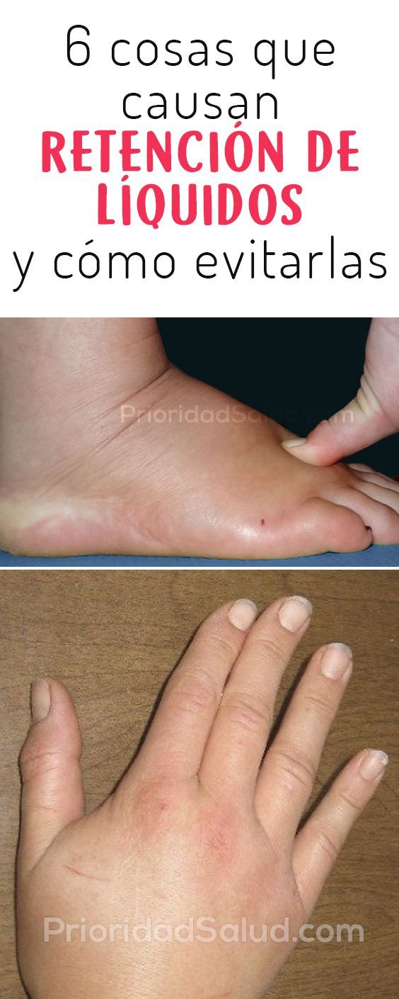 De varices edema tobillo