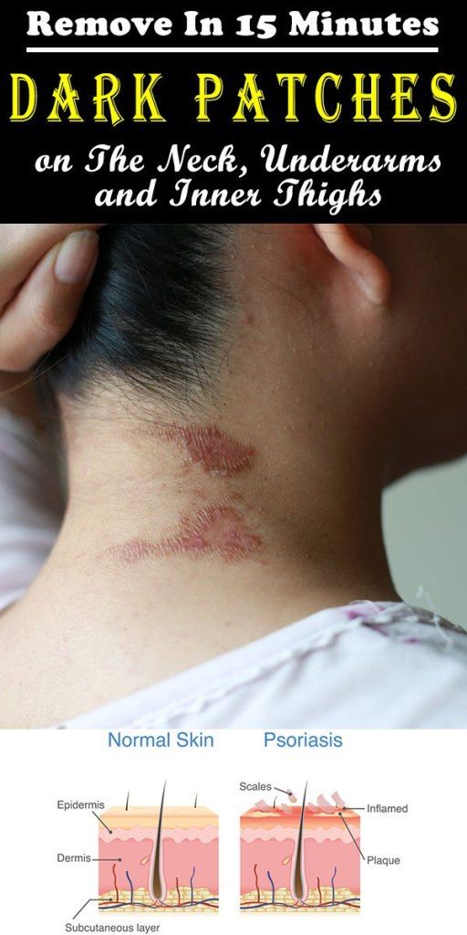 Tthose Annoying Dark Patches On The Neck Underarms And Inner Thighs In 15 Minutes Brown Spots On Face Spots On Face Brown Spots On Skin