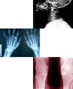 hernias de ballroom y artrosis