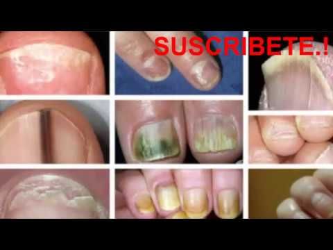 youtube cirugía de próstata en vivo