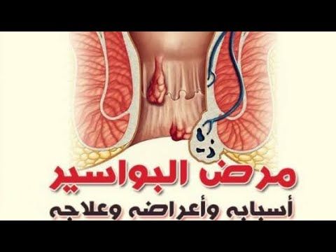 علاج البواسير بدون جراحة بالأعشاب الطبيعية Almaleka Com Hemorrhoids Treatment Hemorrhoids Bleeding Hemorrhoids