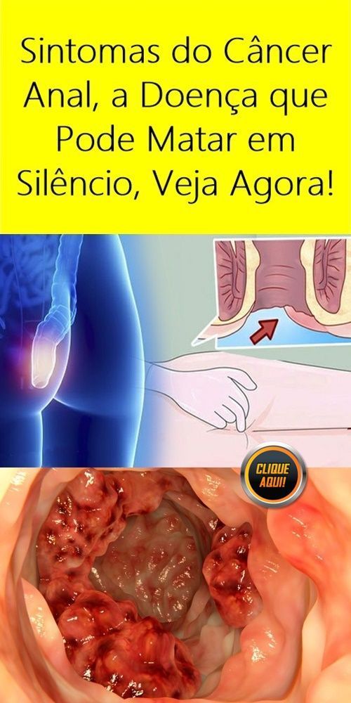 Quero uma mulher para fazer sexo Primeiros sintomas de cancer anal