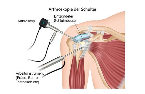 Schulterschmerzen Ursachen Behandlung Ubungen Schulter