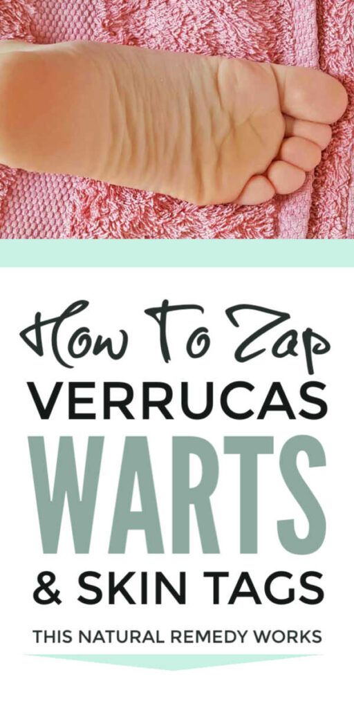 Get Rid Of Verrucas Warts Naturally Skin Tags Home Remedies Natural Remedies Natural Cough Remedies