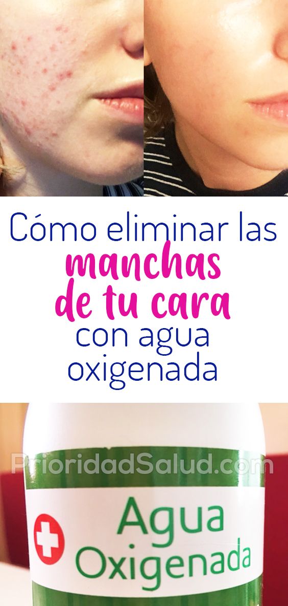 Psago18 Como Eliminar Las Manchas De Tu Cara Con Agua Oxigenada Acne Healthy Recipes Exfoliating