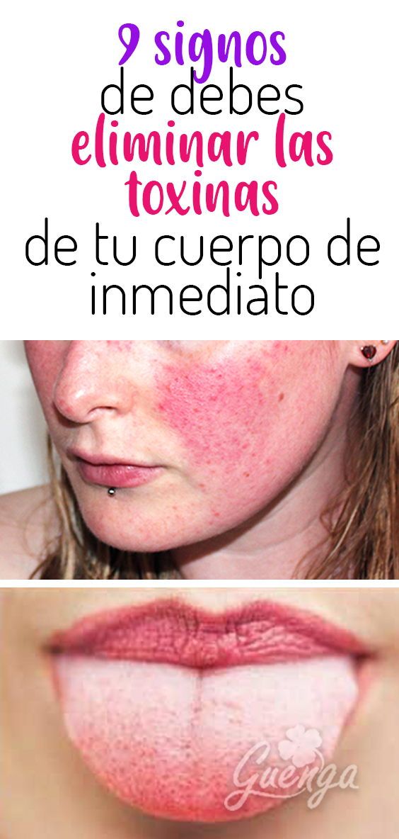 como eliminar el exceso de grasa en la cabeza
