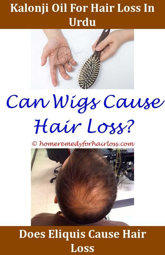 Pin On Hair Loss Stinks