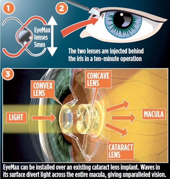 The Wide Screen Eye Implant Giving Hope To Millions Uk Health