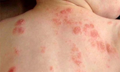 Bệnh viêm da cơ địa