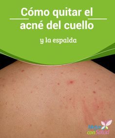 porque te sale acne en la espalda
