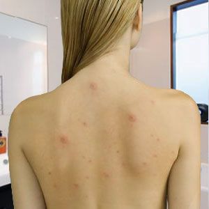 Pin By Sydd Green On Hair And Beauty Back Acne Treatment Back Acne Remedies Acne Remedies