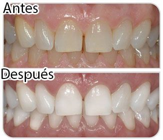 Pin On Como Blanquear Los Dientes
