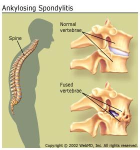 Ankylosing Spondylitis As Ankylosing Spondylitis Ankylosing Spondylitis Symptoms Arthritis Treatment