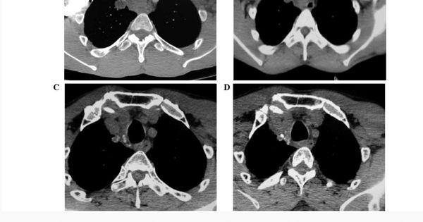 tracheobronchialis papillomatosis)